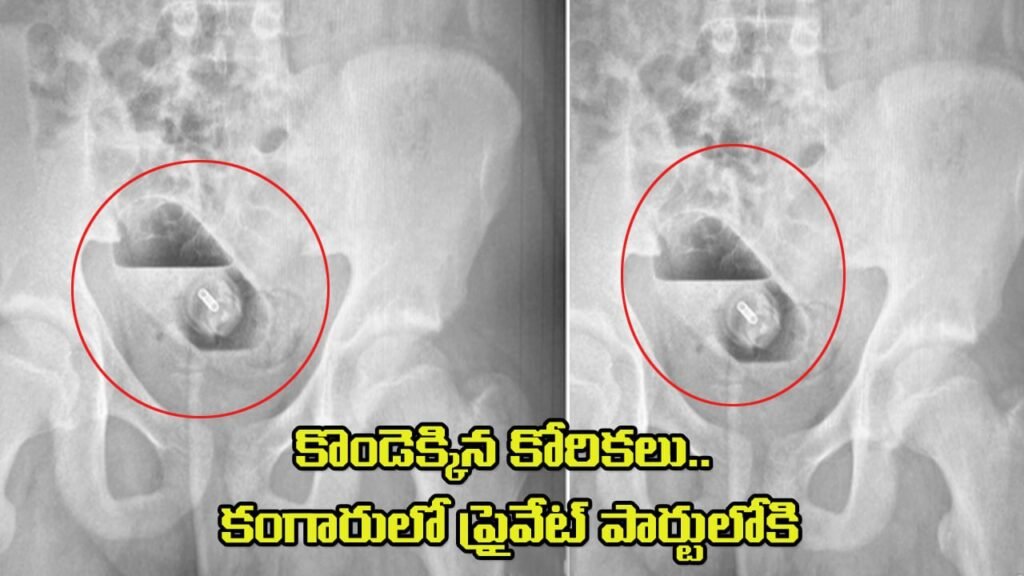 x-ray,exploratory laparotomy,colonoscopy,perfume bottle,uk medical case,foreign object removal,teen health,unusual medical cases,అసాధారణ వైద్య కేసులు,ఎక్స్-రే,లాపరోటమీ,కొలొనోస్కోపీ,యువత ఆరోగ్యం x-ray, exploratory laparotomy, colonoscopy, perfume bottle, uk medical case, foreign object removal, teen health, unusual medical cases, అసాధారణ వైద్య కేసులు, ఎక్స్-రే, లాపరోటమీ, కొలొనోస్కోపీ, యువత ఆరోగ్యం