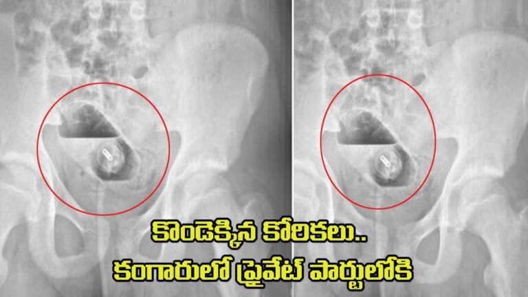 Viral: కొండెక్కిన కోరికలు.. కంగారులో ప్రైవేట్ పార్టులోకి.. ఆపై X-Ray తీయగా!